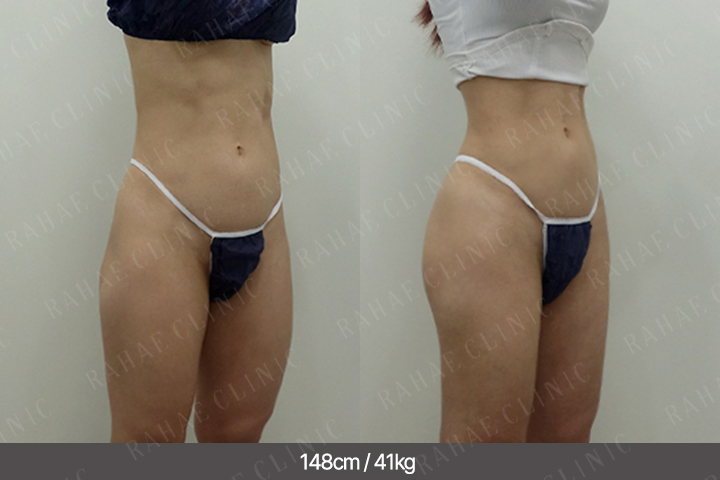 수술정보 <span>골반지방이식+엉덩이지방이식+복부지방흡입