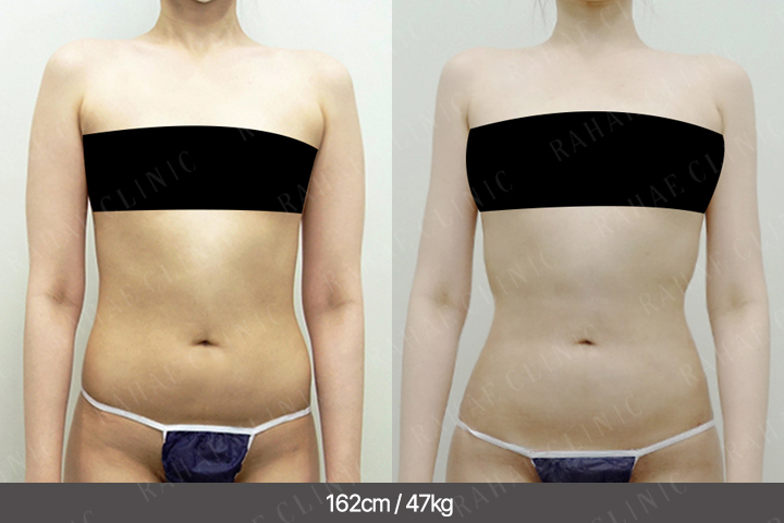 수술정보 <span>팔지방흡입+골반지방이식+엉덩이지방이식