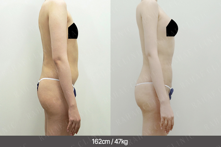 수술정보 <span>팔지방흡입+골반지방이식+엉덩이지방이식