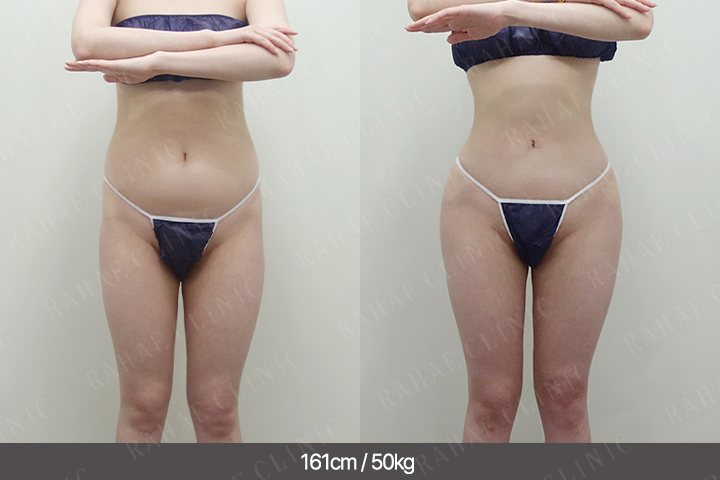 수술정보 <span>골반지방이식+엉덩이지방이식+복부지방흡입