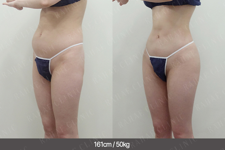 수술정보 <span>골반지방이식+엉덩이지방이식+복부지방흡입