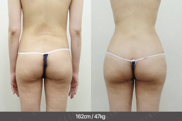 수술정보 <span>엉덩이지방이식+골반지방이식+복부지방흡입