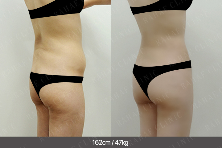 수술정보 <span>엉덩이지방이식+골반지방이식+복부지방흡입