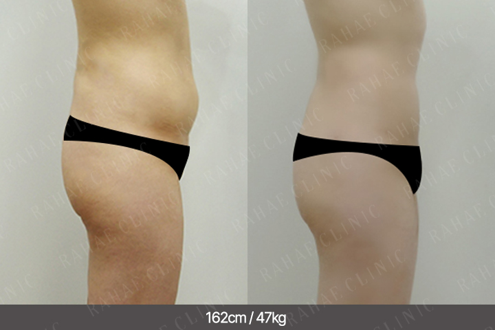 수술정보 <span>엉덩이지방이식+골반지방이식+복부지방흡입