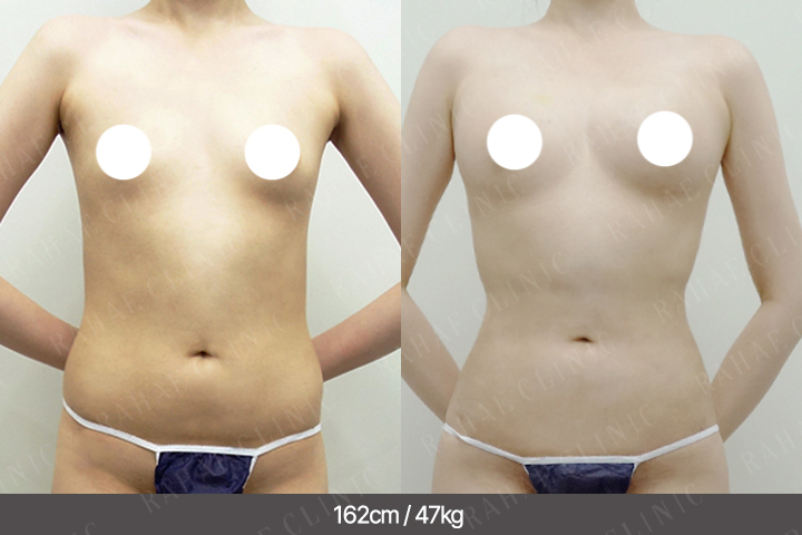 수술정보 <span>가슴지방이식+골반지방이식+엉덩이지방이식+팔지방흡입