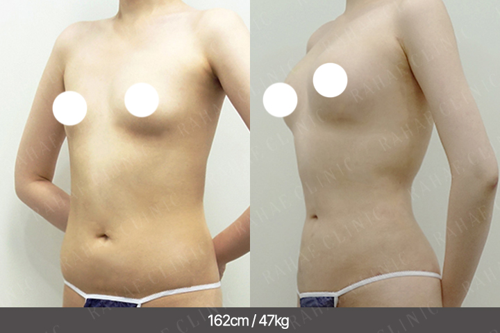 수술정보 <span>가슴지방이식+골반지방이식+엉덩이지방이식+팔지방흡입