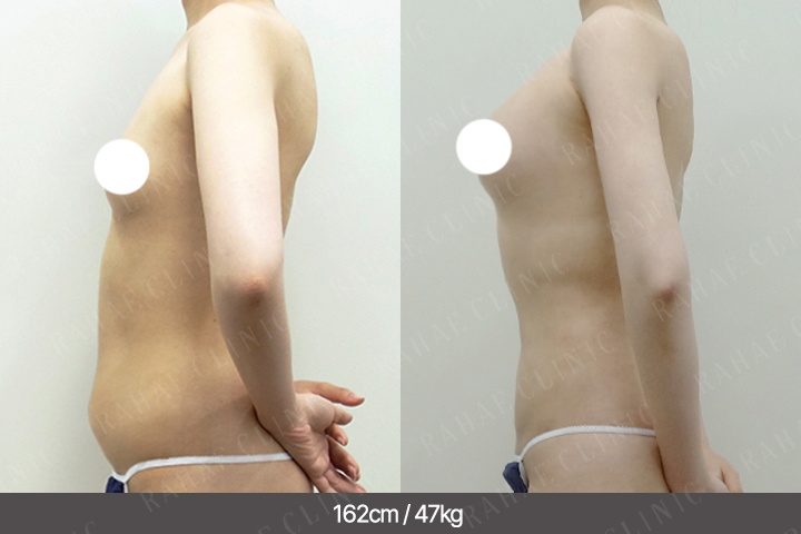 수술정보 <span>가슴지방이식+골반지방이식+엉덩이지방이식+팔지방흡입