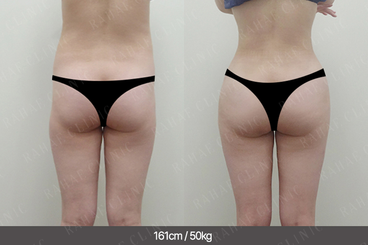 수술정보 <span>엉덩이지방이식+골반지방이식+복부지방흡입