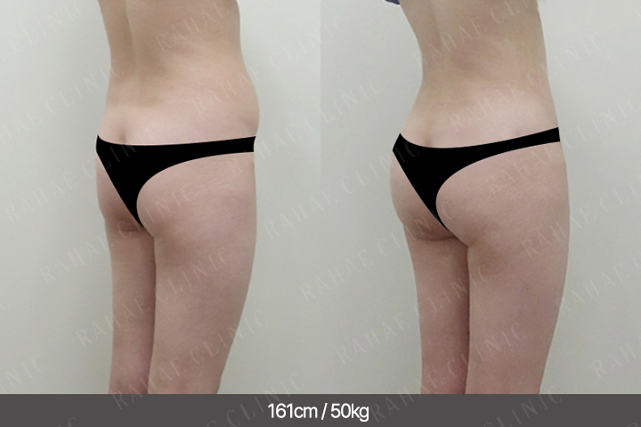 수술정보 <span>엉덩이지방이식+골반지방이식+복부지방흡입