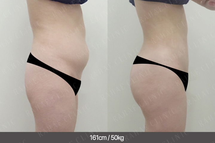 수술정보 <span>엉덩이지방이식+골반지방이식+복부지방흡입