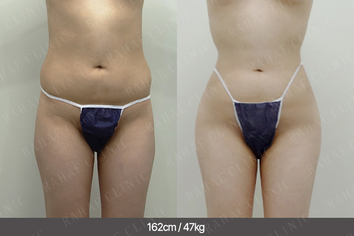 수술정보 <span>골반지방이식+엉덩이지방이식+복부지방흡입