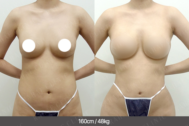 수술정보 <span>가슴지방이식+엉덩이지방이식+복부지방흡입