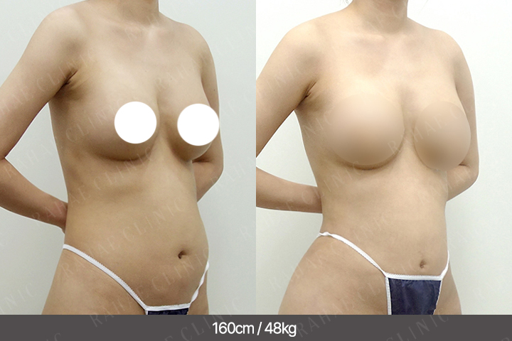 수술정보 <span>가슴지방이식+엉덩이지방이식+복부지방흡입