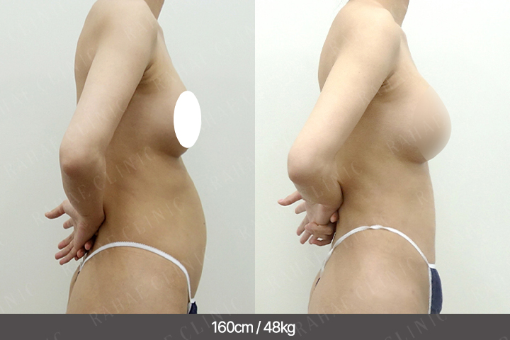 수술정보 <span>가슴지방이식+엉덩이지방이식+복부지방흡입