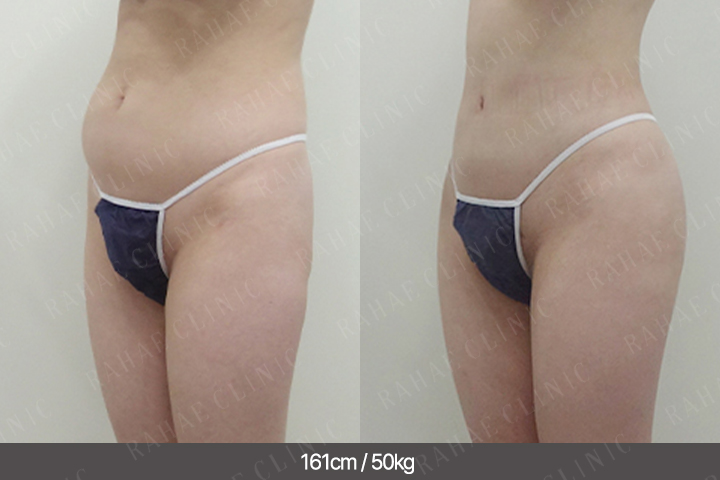 수술정보 <span>복부지방흡입+골반지방이식+엉덩이지방이식