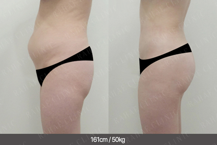 수술정보 <span>복부지방흡입+골반지방이식+엉덩이지방이식