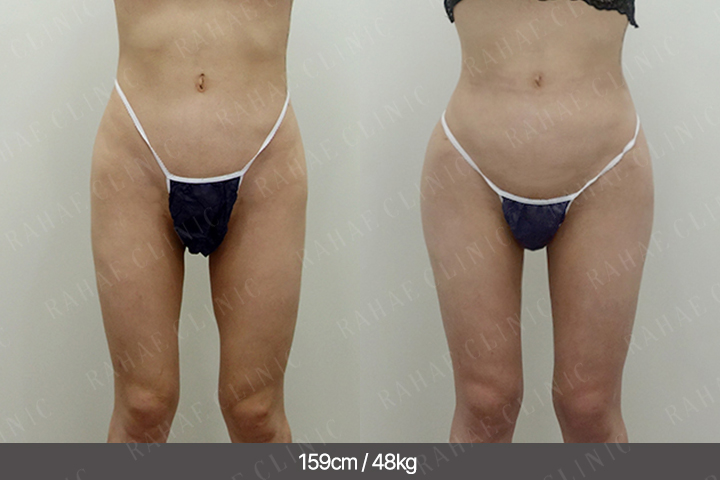 수술정보 <span>골반지방이식+엉덩이지방이식+복부지방흡입