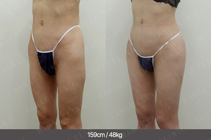 수술정보 <span>골반지방이식+엉덩이지방이식+복부지방흡입