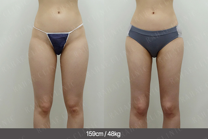 수술정보 <span>허벅지지방흡입+골반지방이식+엉덩이지방이식