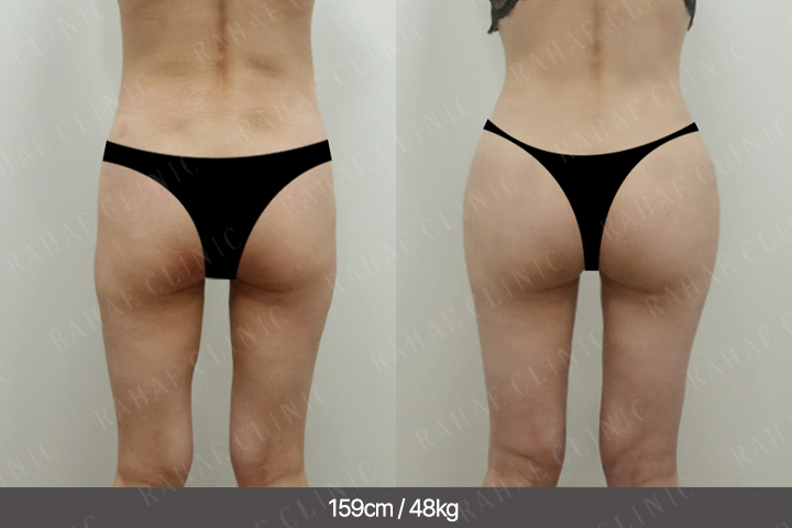 수술정보 <span>골반지방이식+엉덩이지방이식+복부지방흡입