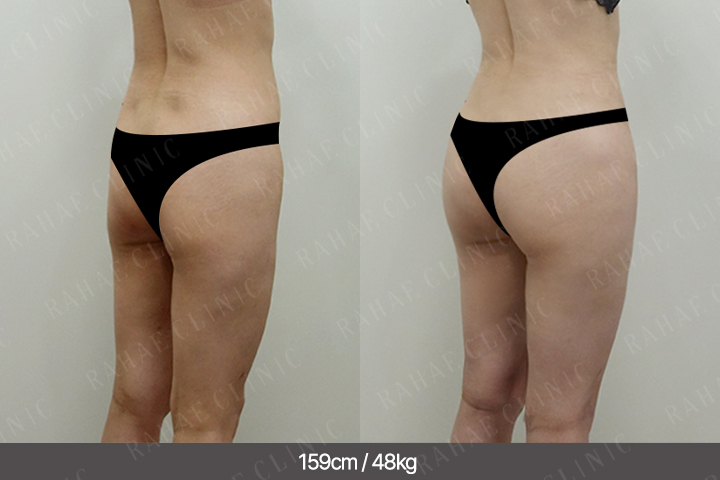 수술정보 <span>골반지방이식+엉덩이지방이식+복부지방흡입