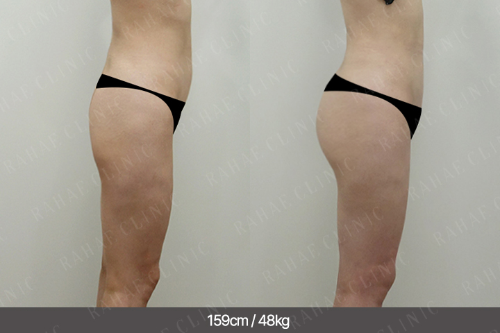 수술정보 <span>골반지방이식+엉덩이지방이식+복부지방흡입