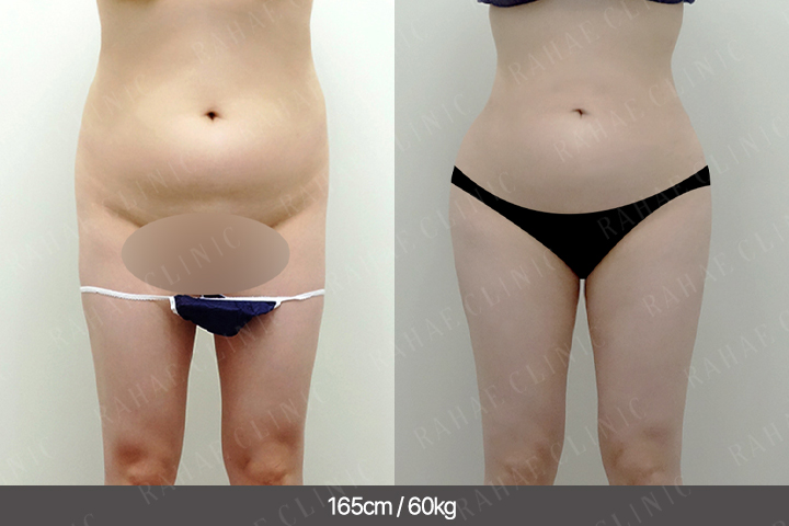 수술정보 <span>골반지방이식+엉덩이지방이식+복부지방흡입