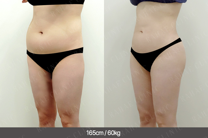 수술정보 <span>골반지방이식+엉덩이지방이식+복부지방흡입