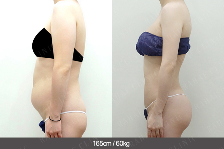 수술정보 <span>팔지방흡입+복부지방흡입+골반지방이식+엉덩이지방이식