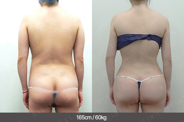 수술정보 <span>팔지방흡입+복부지방흡입+골반지방이식+엉덩이지방이식