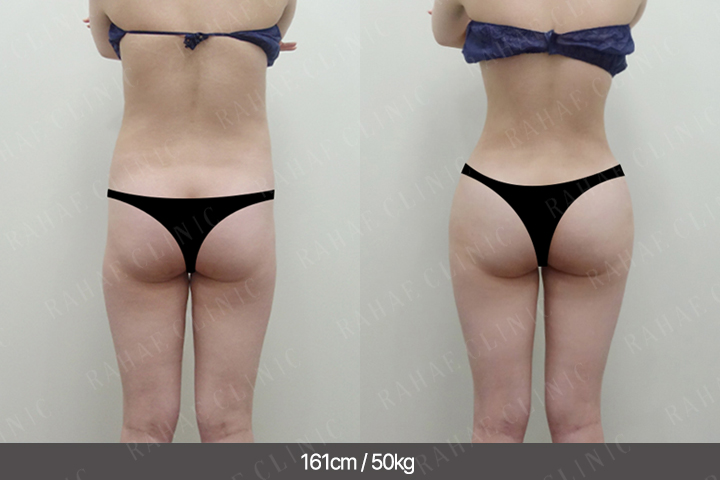 수술정보 <span>엉덩이지방이식+골반지방이식+복부지방흡입