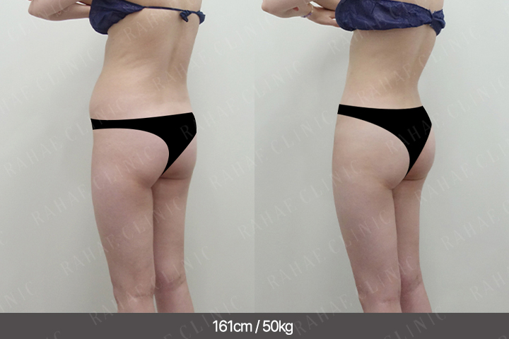 수술정보 <span>엉덩이지방이식+골반지방이식+복부지방흡입