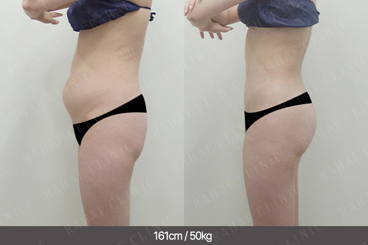 수술정보 <span>엉덩이지방이식+골반지방이식+복부지방흡입