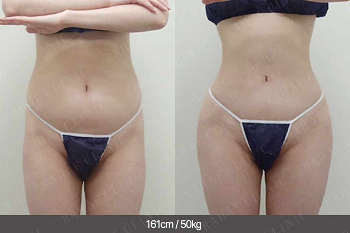 수술정보 <span>복부지방흡입+골반지방이식+엉덩이지방이식