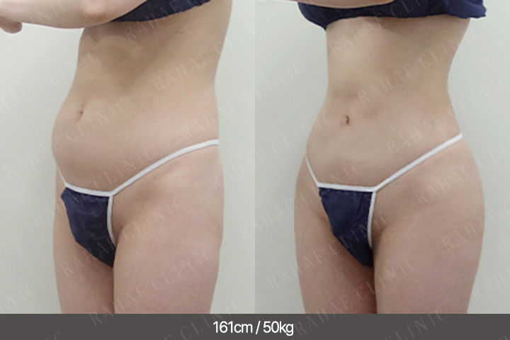 수술정보 <span>복부지방흡입+골반지방이식+엉덩이지방이식