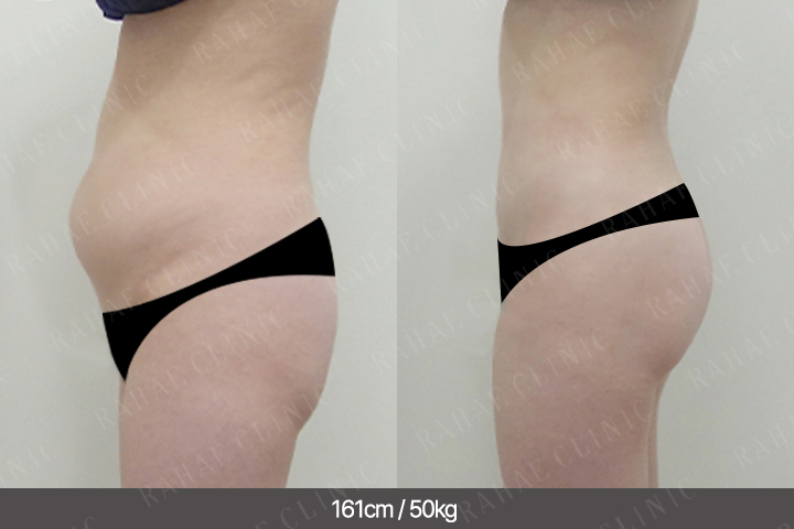 수술정보 <span>복부지방흡입+골반지방이식+엉덩이지방이식