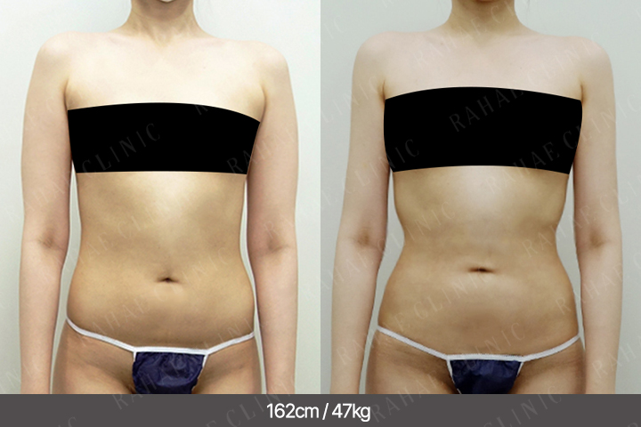 수술정보 <span>팔지방흡입+골반지방이식+가슴지방이식