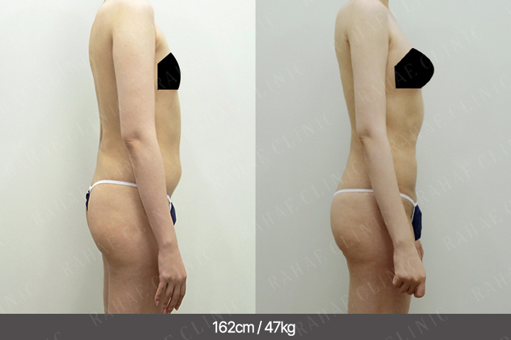 수술정보 <span>팔지방흡입+골반지방이식+가슴지방이식