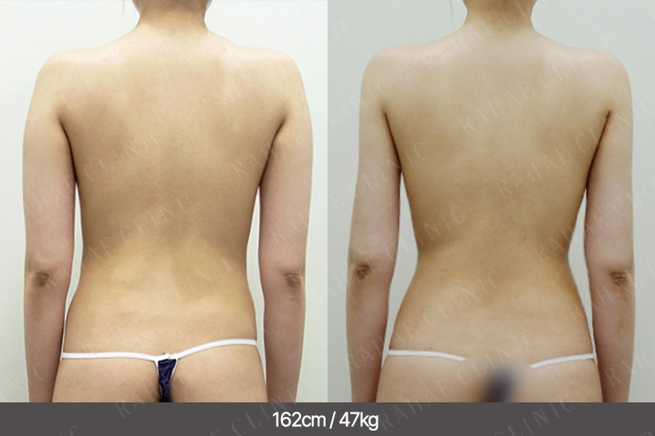 수술정보 <span>팔지방흡입+골반지방이식+가슴지방이식