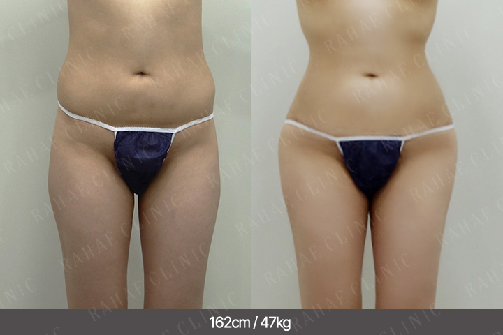 수술정보 <span>골반지방이식+엉덩이지방이식+복부지방흡입