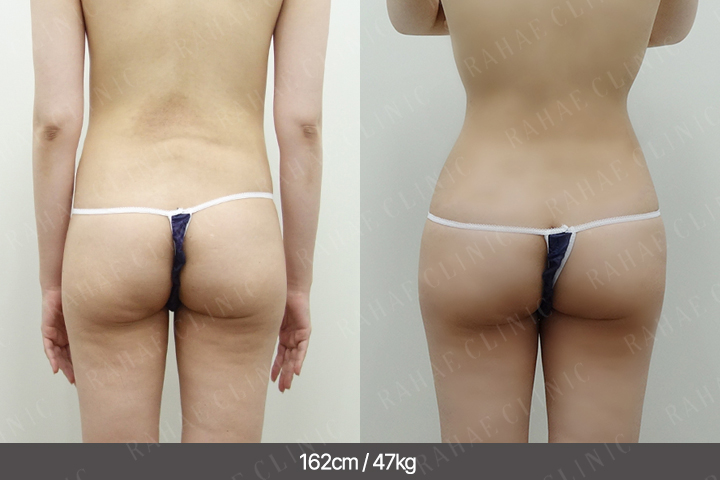 수술정보 <span>엉덩이지방이식+골반지방이식+복부지방흡입