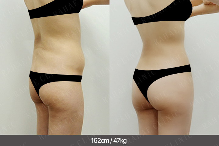 수술정보 <span>엉덩이지방이식+골반지방이식+복부지방흡입