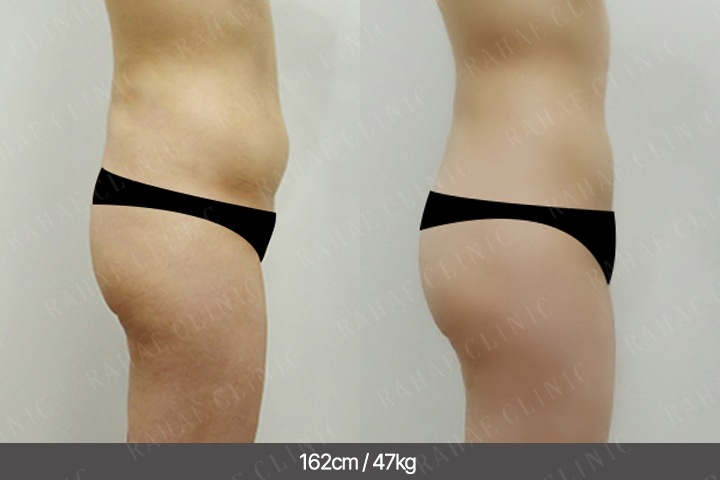 수술정보 <span>엉덩이지방이식+골반지방이식+복부지방흡입