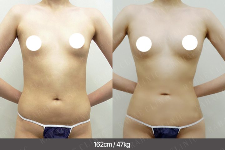 수술정보 <span>가슴지방이식+복부지방흡입