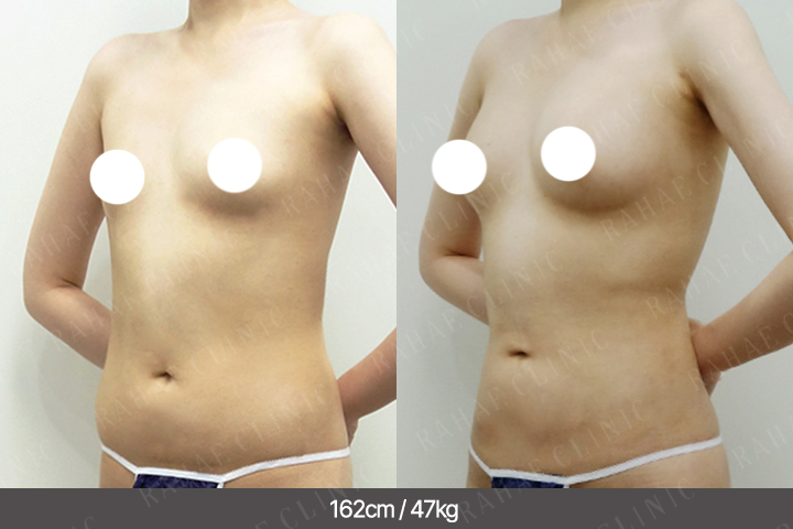 수술정보 <span>가슴지방이식+복부지방흡입