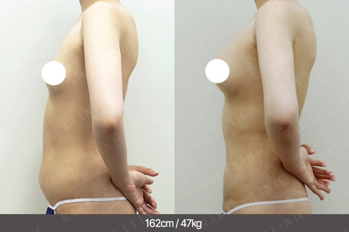 수술정보 <span>가슴지방이식+복부지방흡입