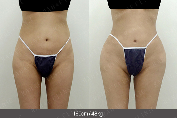 수술정보 <span>골반지방이식+엉덩이지방이식+복부지방흡입