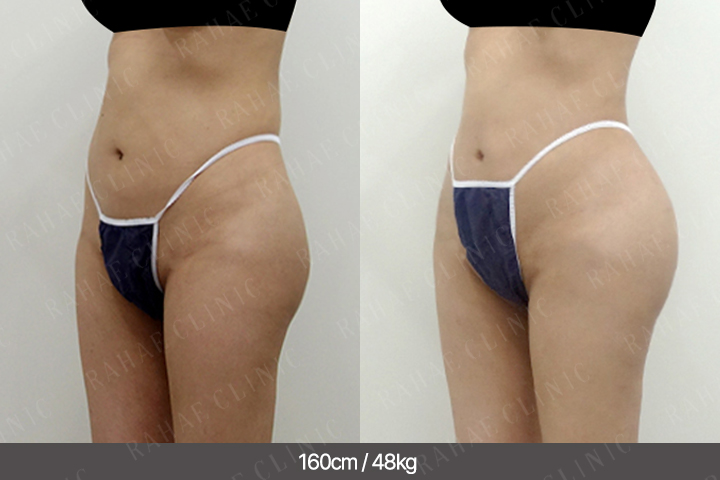 수술정보 <span>골반지방이식+엉덩이지방이식+복부지방흡입