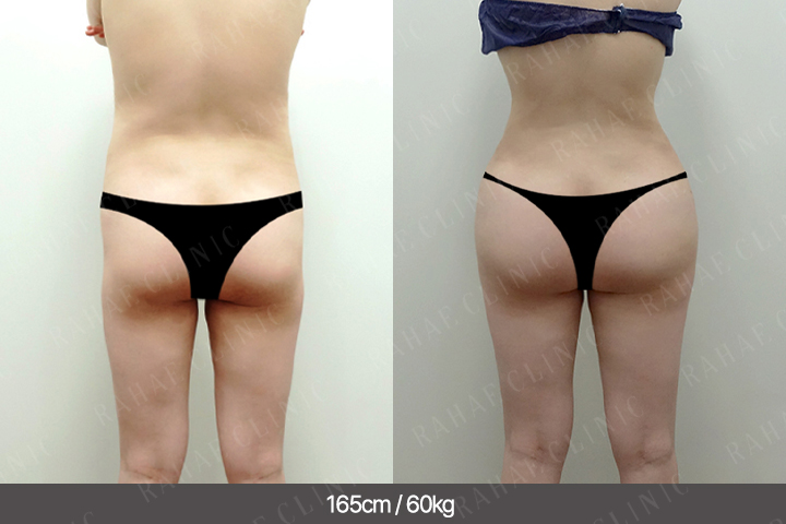 수술정보 <span>엉덩이지방이식+골반지방이식+복부지방흡입