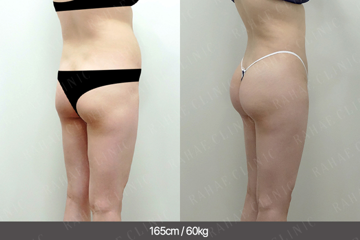 수술정보 <span>엉덩이지방이식+골반지방이식+복부지방흡입